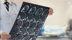 neuralgia