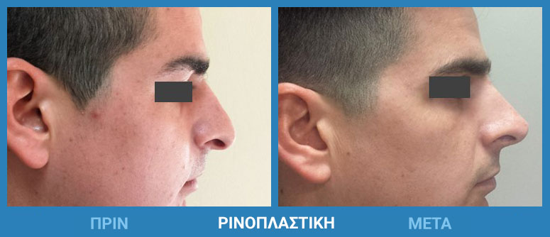 rinoplastiki