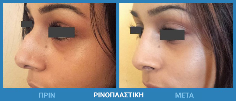 rinoplastiki