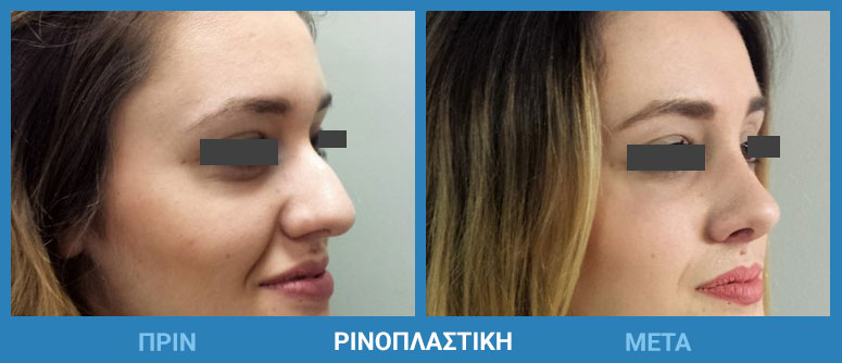 rinoplastiki