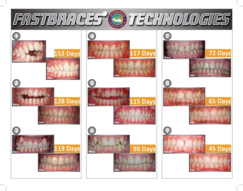 fastbraces before and after- fastbraces πριν και μετά